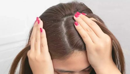 seborrheic dermatitis cream for scalp